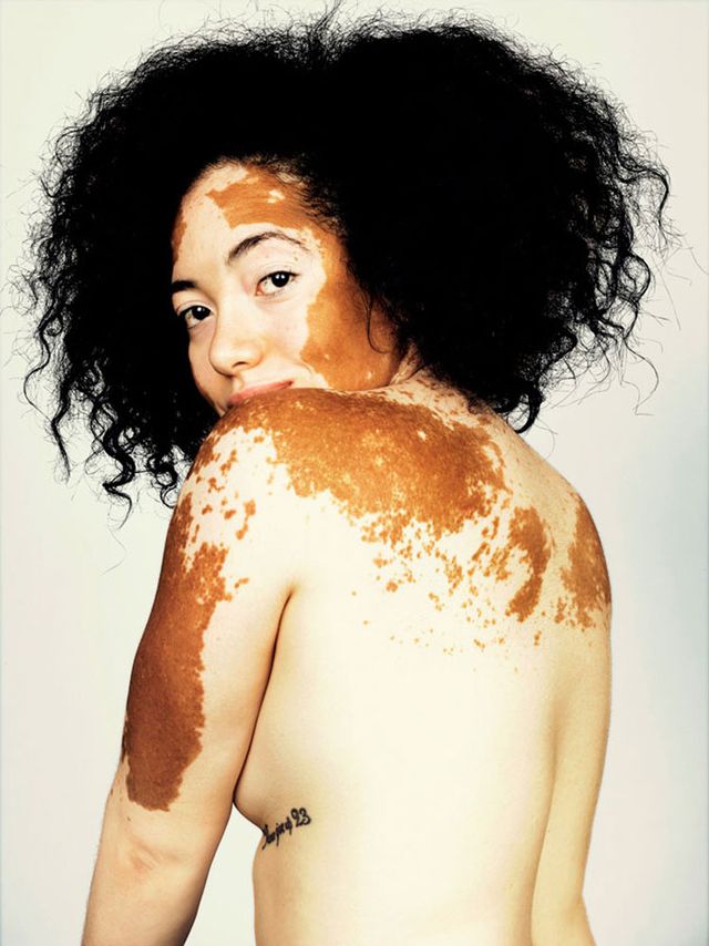 Brock Elbank photos vitiligo