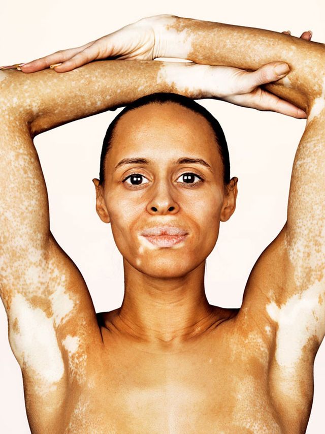 vitiligo brock elbank Instagram