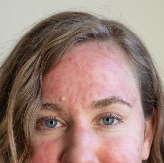bacterial rash on face