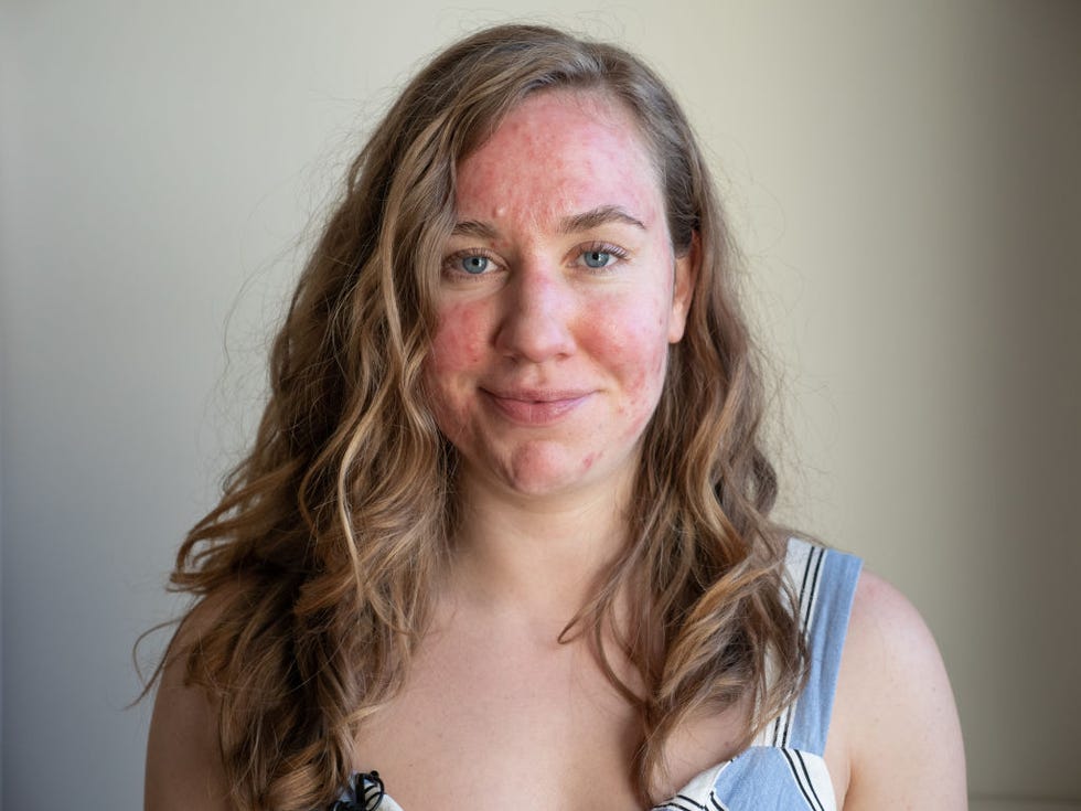 Heat rash store on face