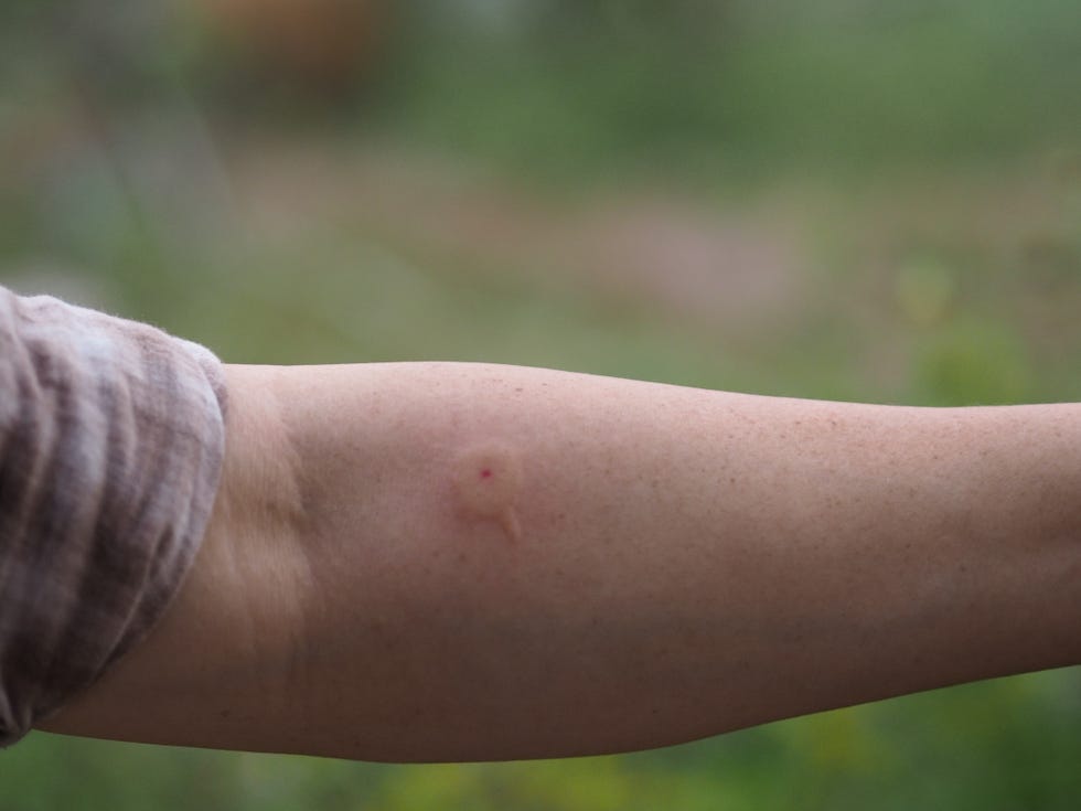 Mosquito Bites on the Skin Under the Breast Stock Photo - Image of body,  blood: 198748858