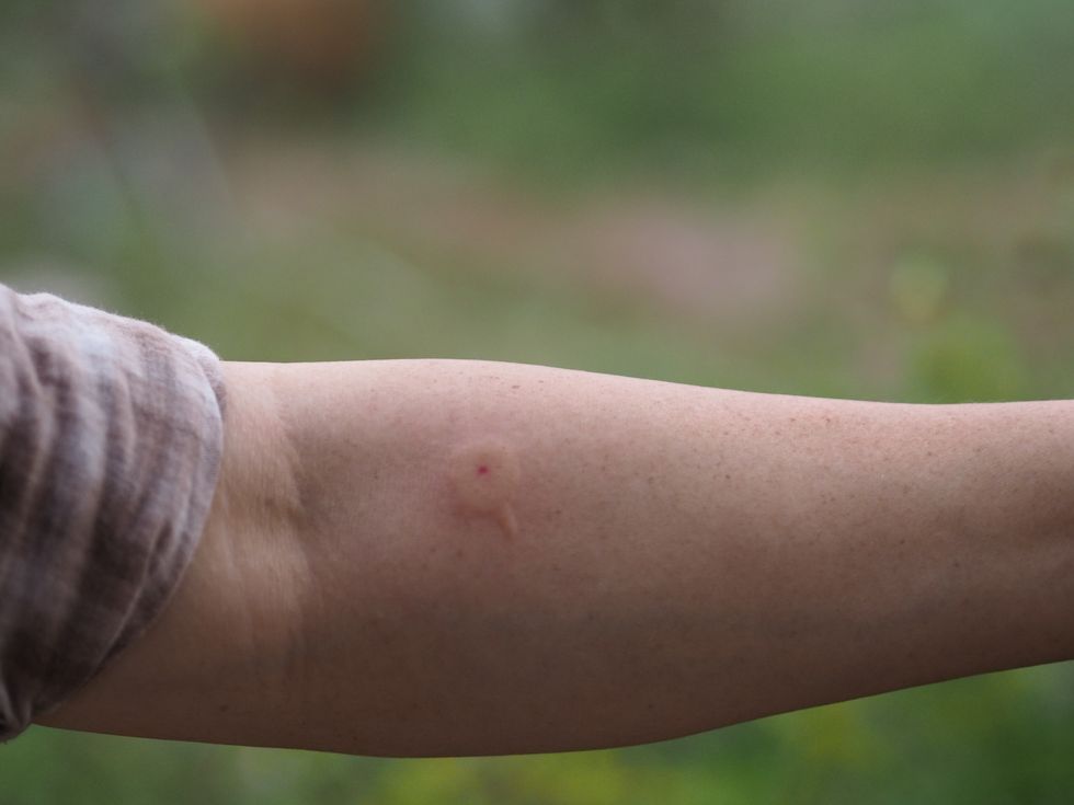 wasp,hornet stings arm woman red swelling