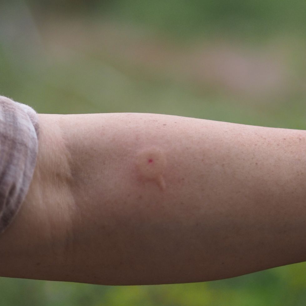 wasp,hornet stings arm woman red swelling
