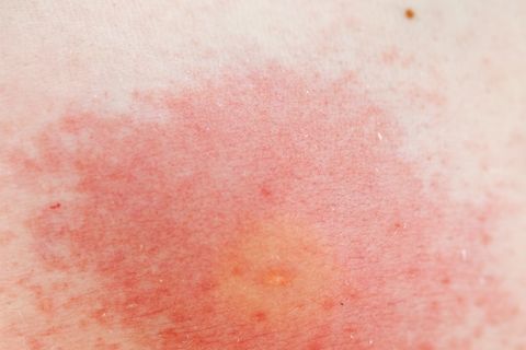 wasp sting allergy