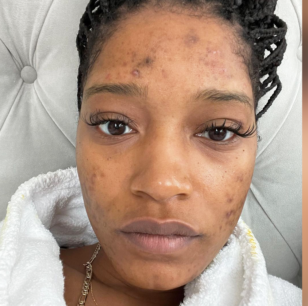 Keke Palmer Talks About Pcos Acne In