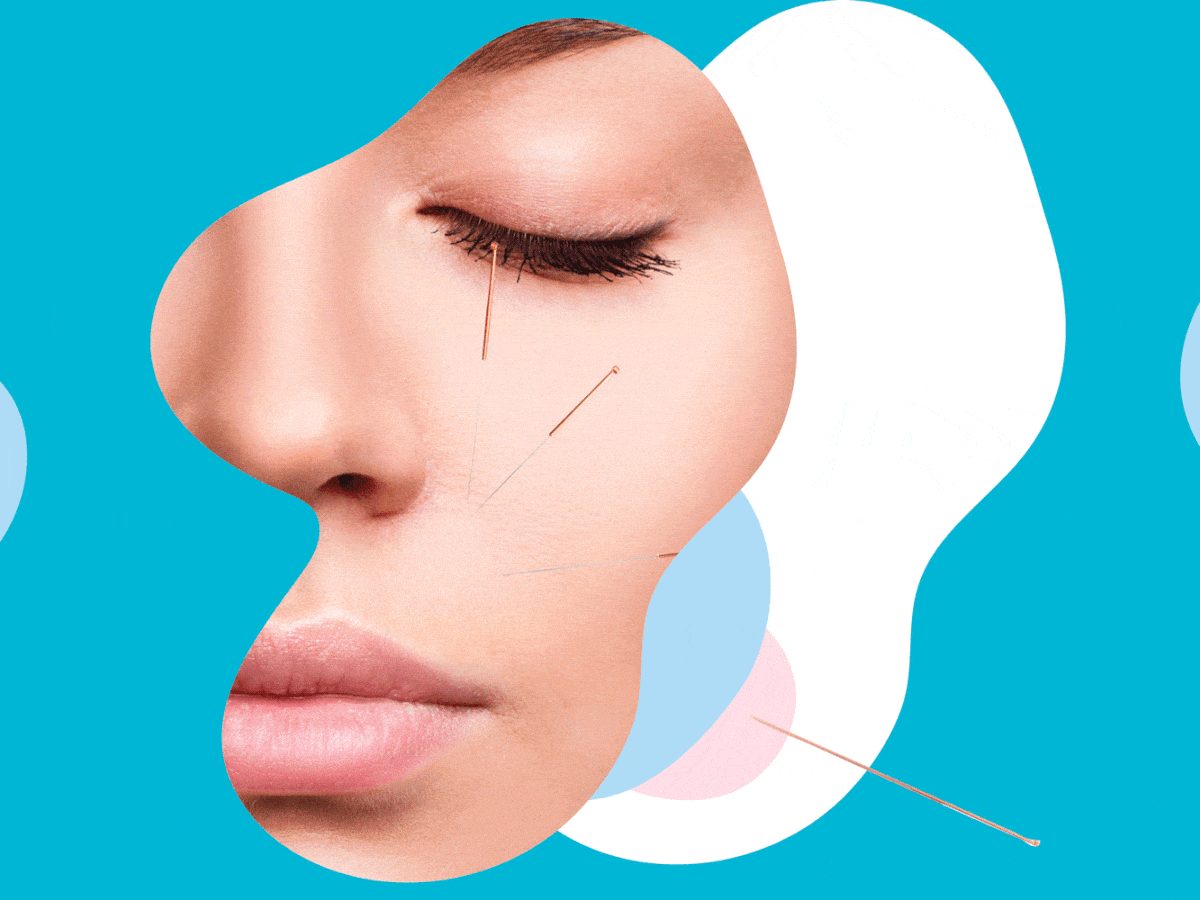 Does Acupuncture For Acne Work? Experts Weigh In