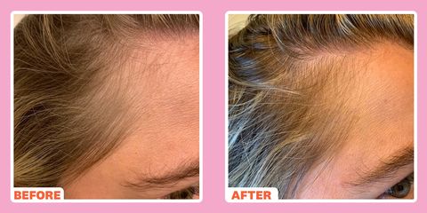 derma roller hair loss before and after