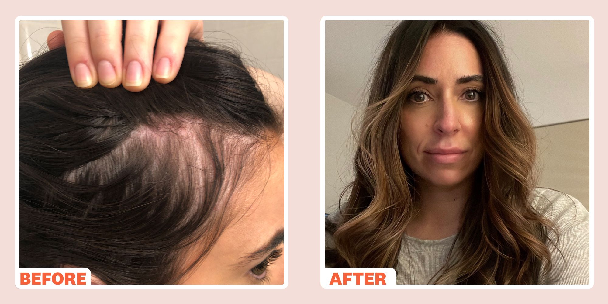 EF MEDISPA  Hair loss or alopecia is one of the most frustrating  conditions for both men and women Male hair loss usually follows a pattern  of a receding hairline followed by