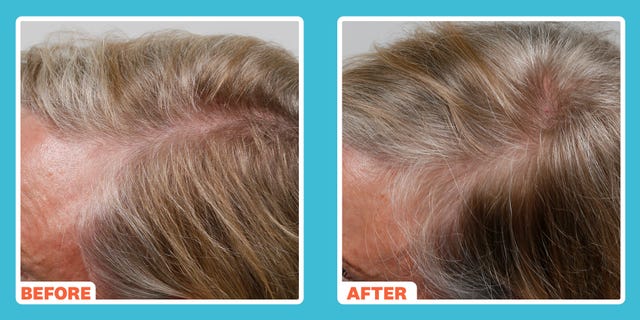 https://hips.hearstapps.com/hmg-prod/images/wh-index-beauty-beforeandafter-hairloss-65f330a22de44.jpg?crop=1.00xw:1.00xh;0,0&resize=640:*