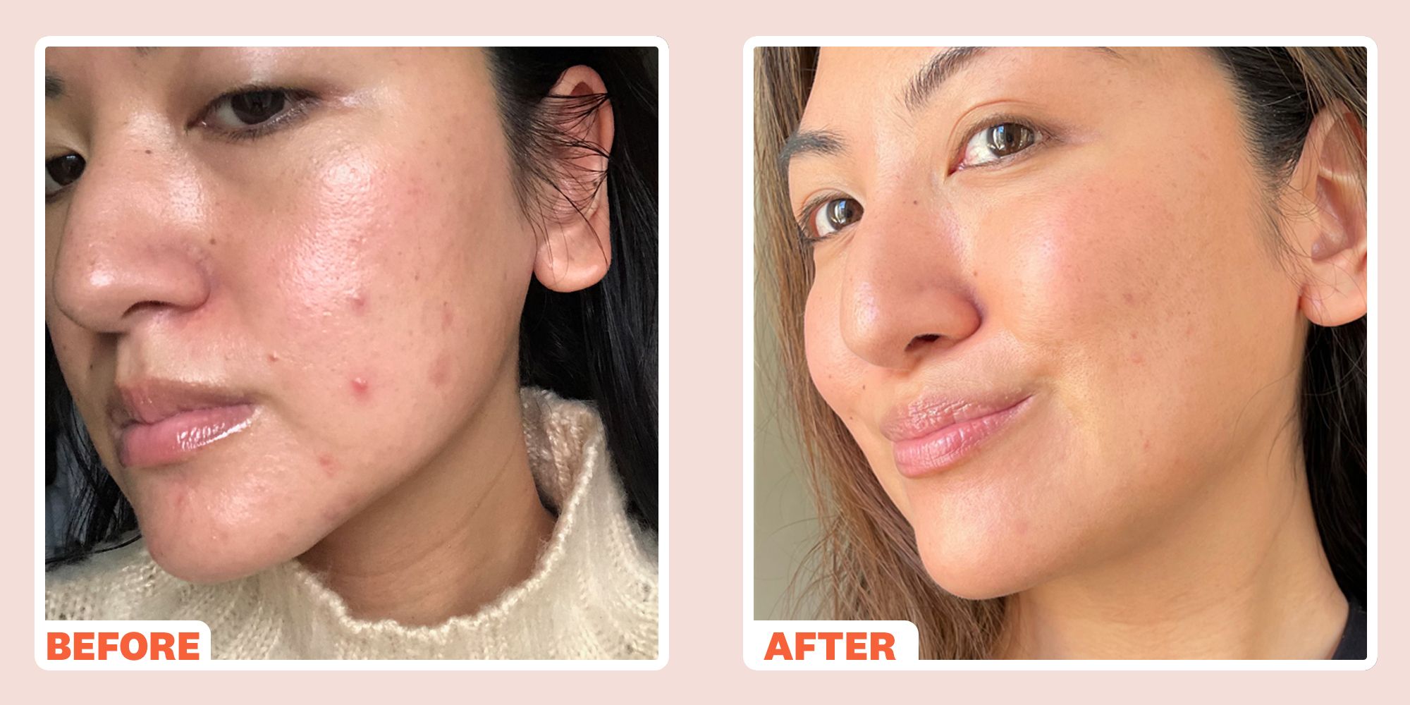 How to Treat Breakouts After Microneedling?  