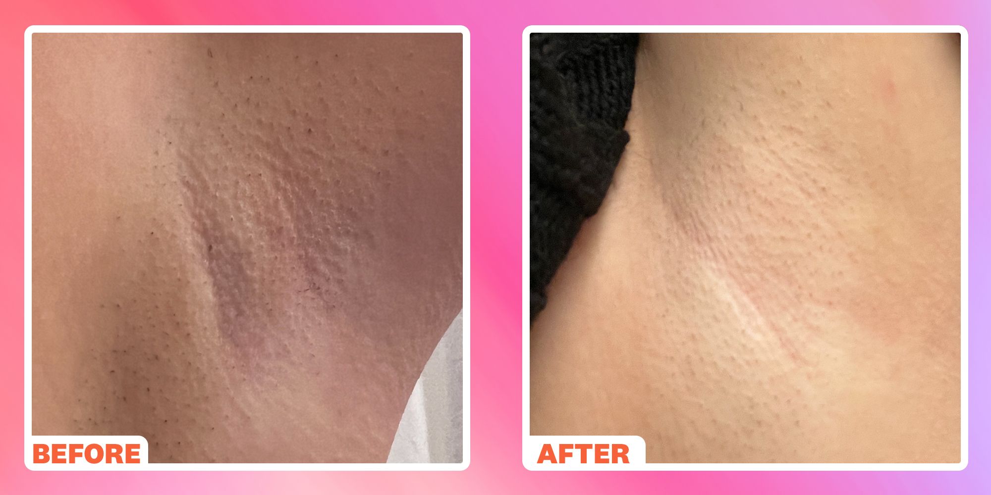 https://hips.hearstapps.com/hmg-prod/images/wh-index-beauty-beforeandafter-testrun-lily-hairremoval-6572162f3b6f9.jpg