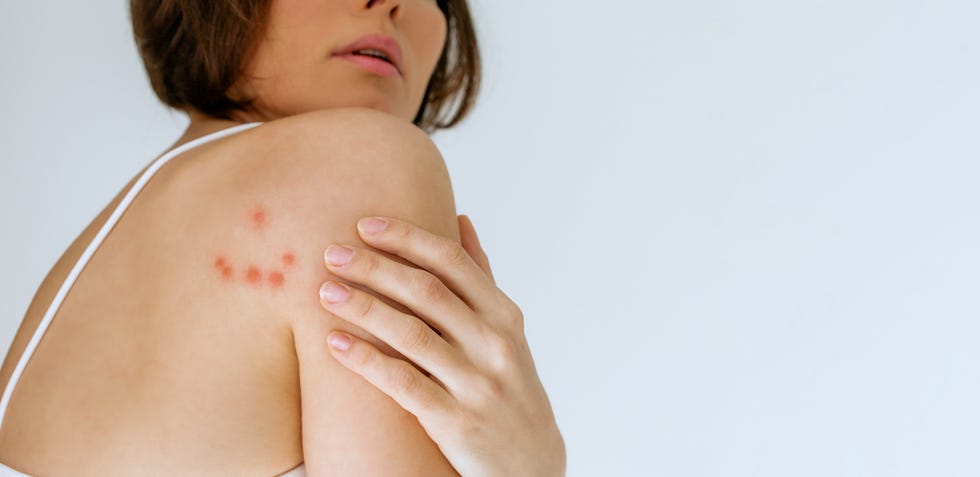 what are signs of bed bugs