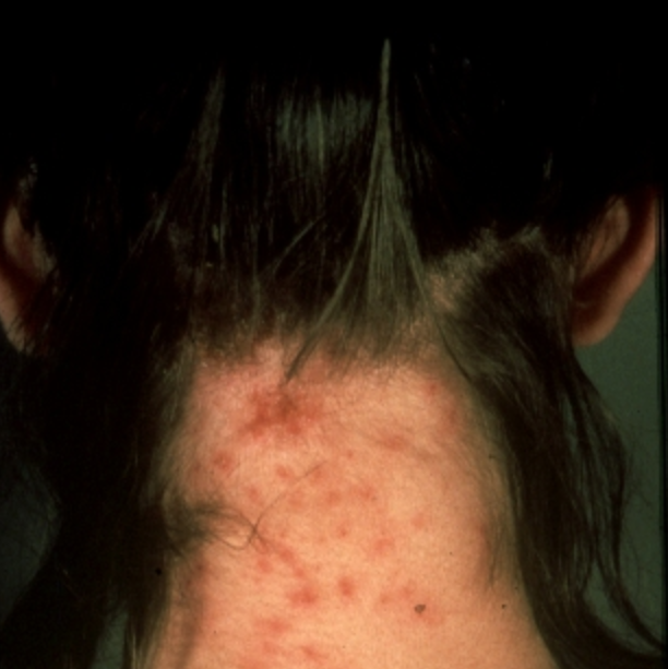 what do head lice bites look like