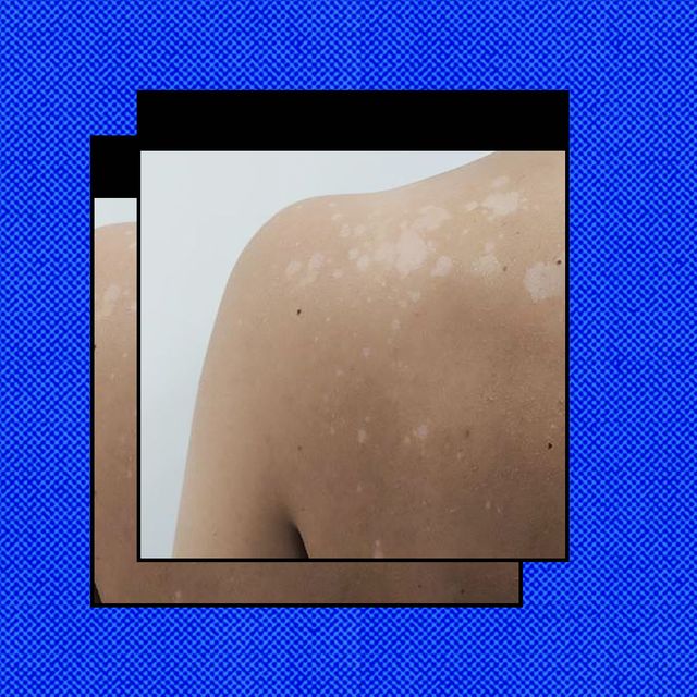 white patches on skin pityriasis versicolor
