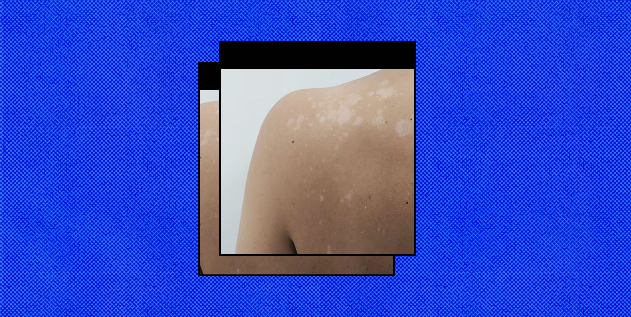 Why Do I Have White Marks On My Skin Infoupdate