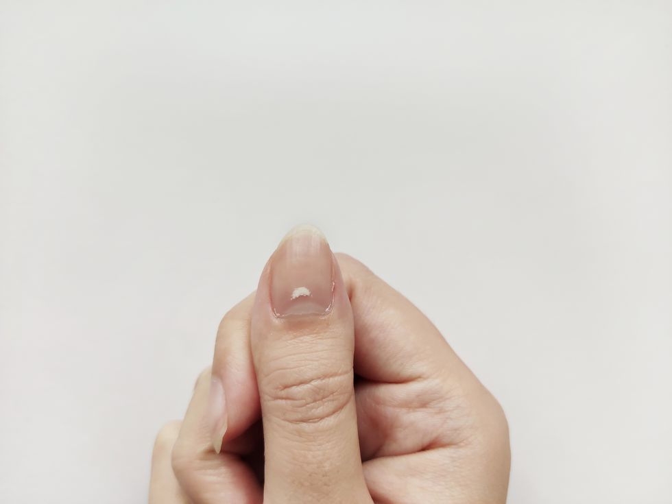 white spots on nail isolated on white background disease leuconychia