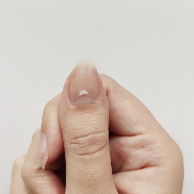 爪の白い斑点については、﻿ビタミンやミネラル不足が原因と聞くことが多いはず。一方で、専門家によればそうしたケースは稀で、最もよくある原因は「爪床の損傷」﻿なのだとか。﻿ ﻿では、﻿﻿実際にどんな治療や予防法があるのでしょうか。爪の白い斑点の正体や原因、白い斑点の予防法について解説します。