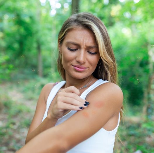young female scratching her itching arm from a mosquito bite at the park during summertime