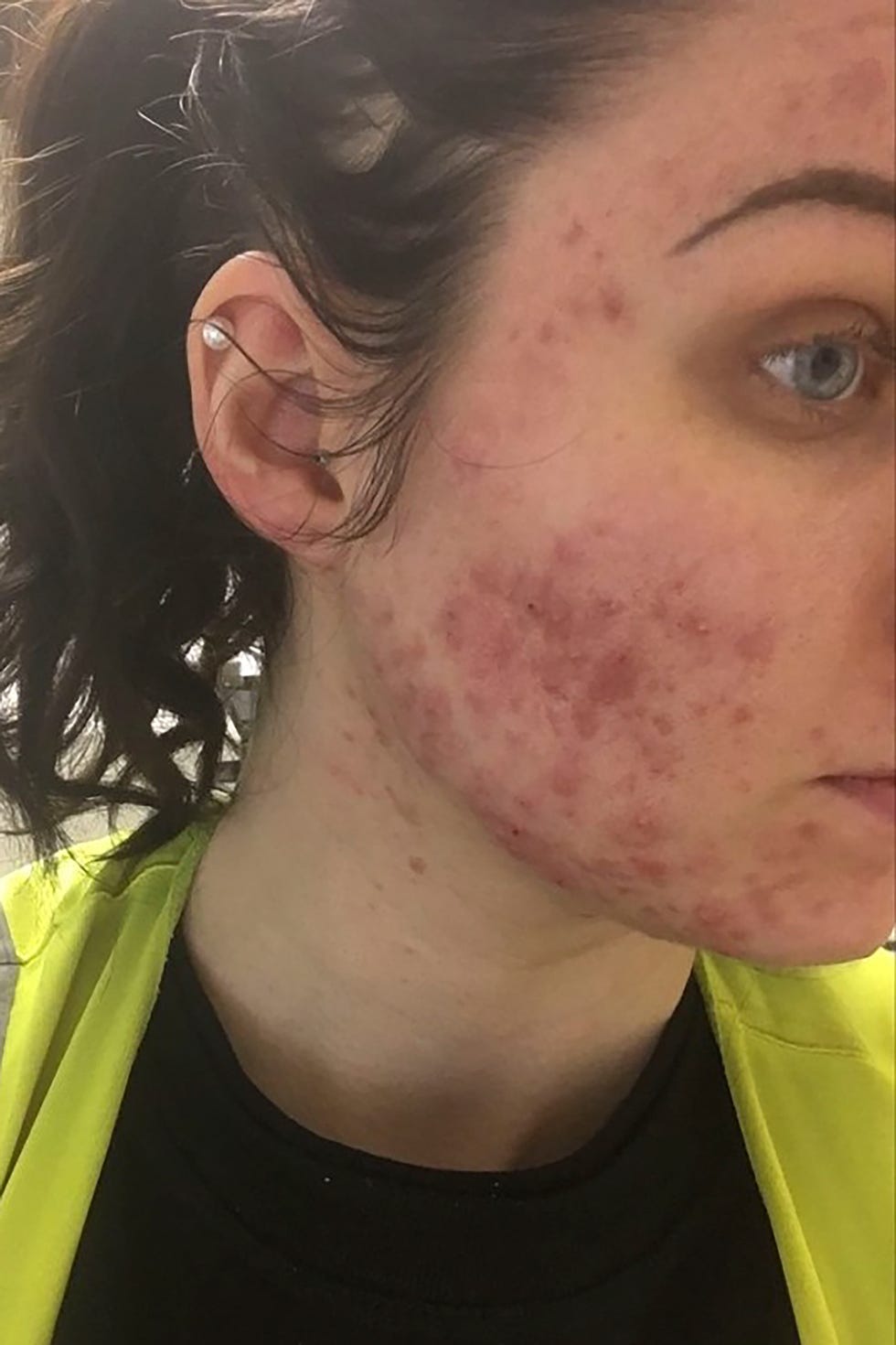 Woman Developed Acne Overnight