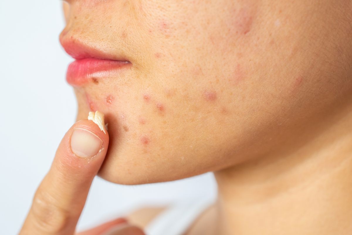 How To Use Retinol To Treat Acne According To Dermatologists