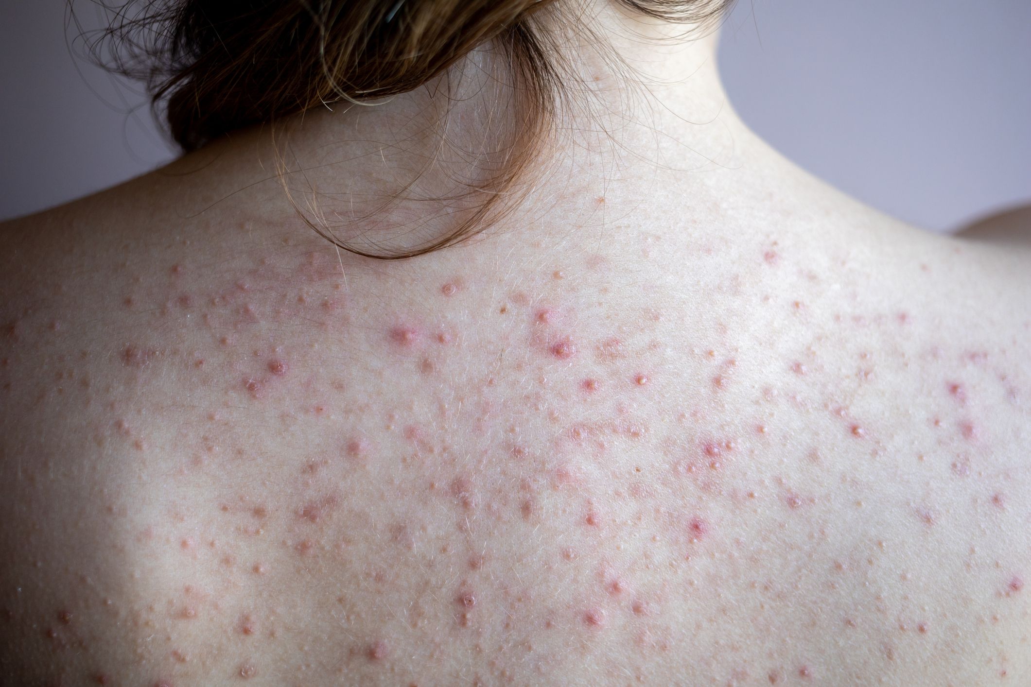 Itchy Skin Bumps On Arms   Woman Back With Acne Red Spots Skin Disease Royalty Free Image 1646431493 