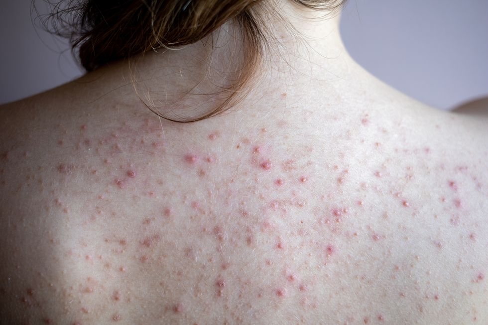 Red Spots on Scalp: Causes, Treatment, and More
