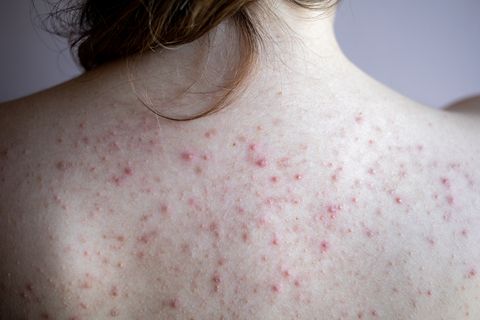 modbydeligt Poleret Sammentræf A Photo Guide To Raised Skin Bumps - Red Moles, Cysts, And More
