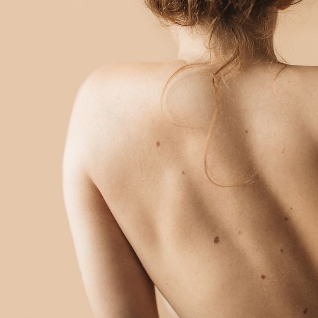 woman with brown spots on back