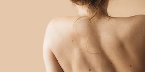 woman with brown spots on back