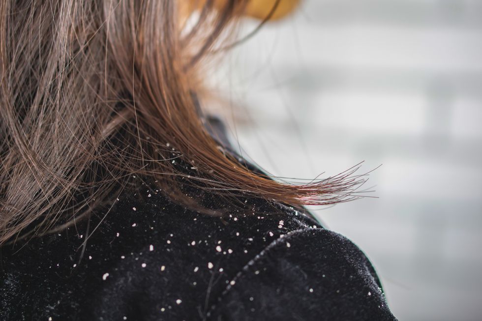 woman hair with dandruff falling on shoulders