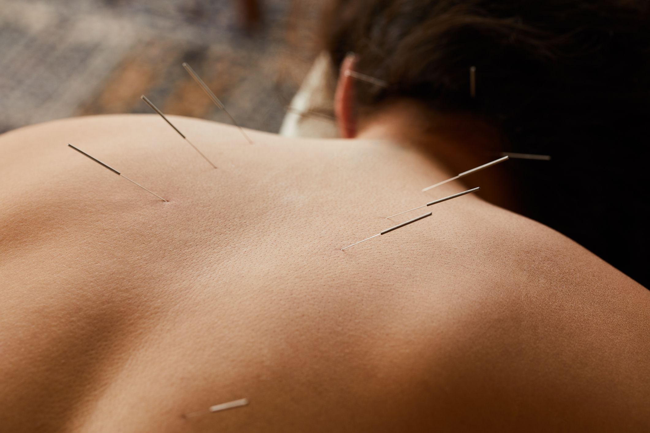 South Kensington Acupuncture, London