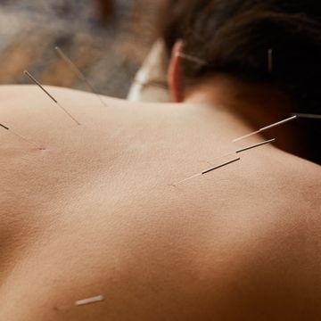 woman having acupuncture done on her back in a clinic