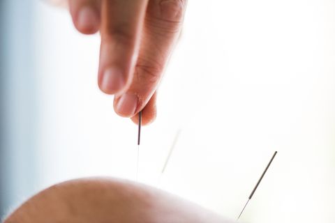 woman having acupuncture treatment on shoulder