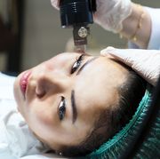 woman having intracel radiofrequency microneedling treatment