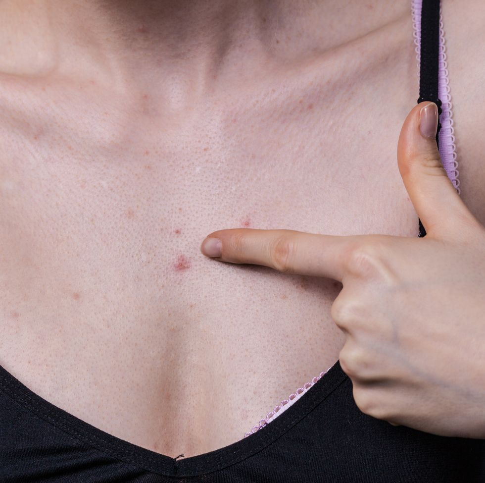 woman having pimples red spots on chest