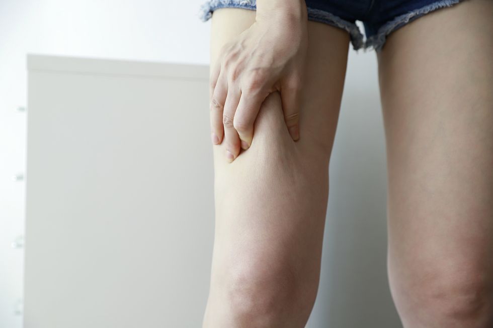 woman pinching thigh cellulite