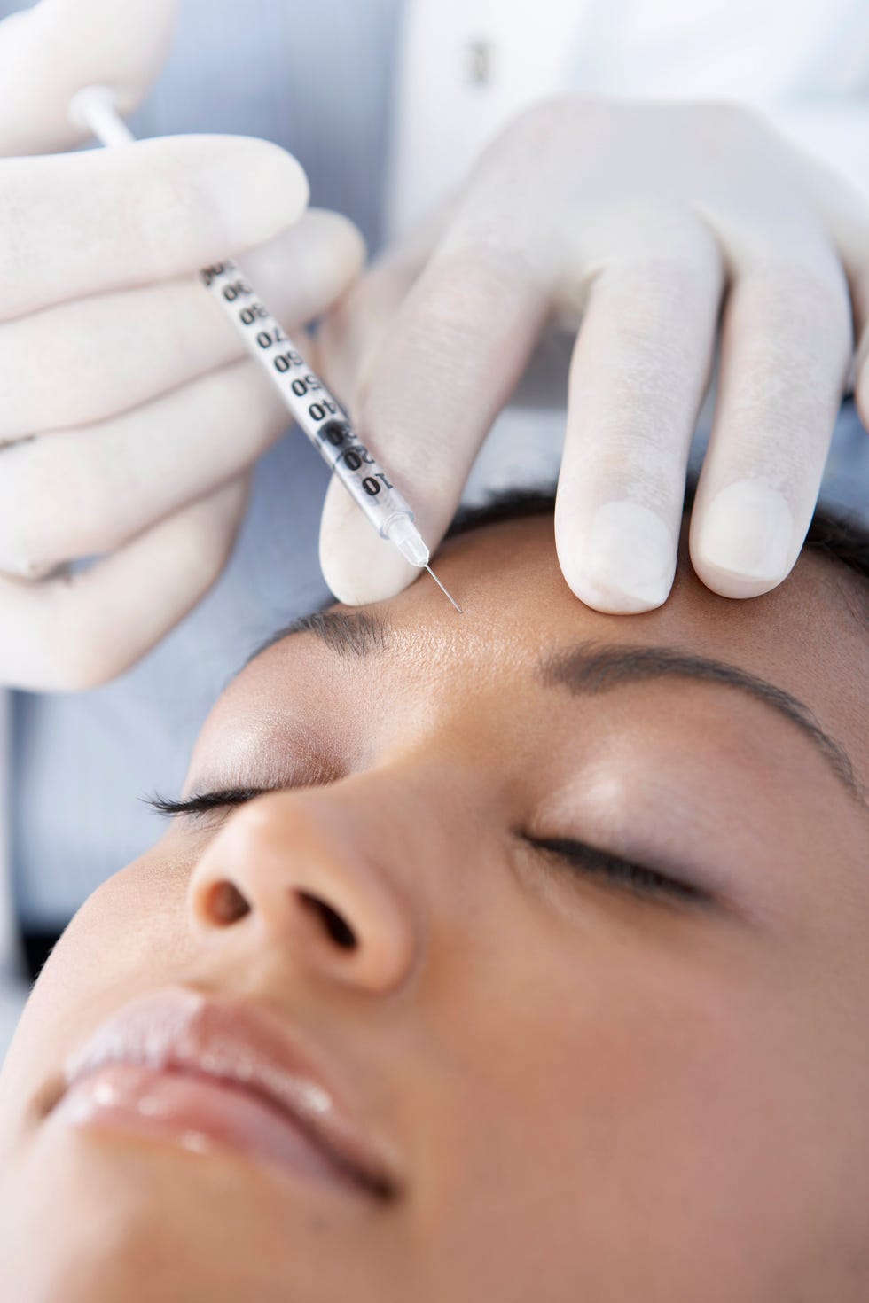 How to treat acne scars - Juvederm
