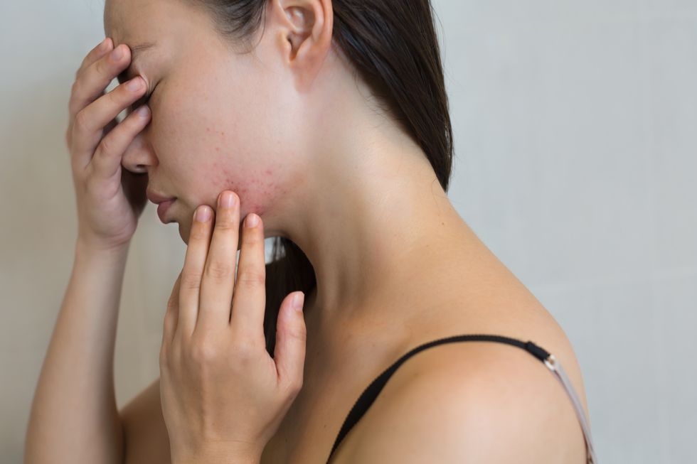 Woman stressed from face acne.