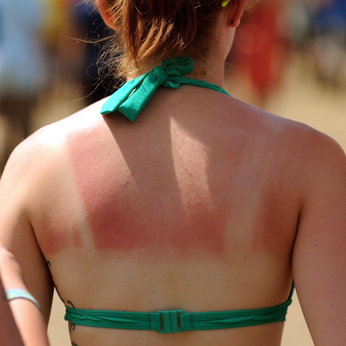 Sunburn: Symptoms & Treatment