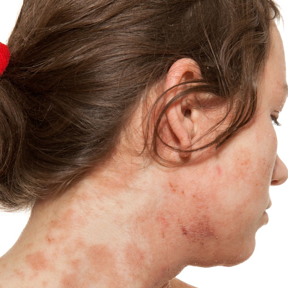 Itchy Rash Pictures: 6 most common cases and their treatment