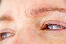 woman with atopic dermatitis