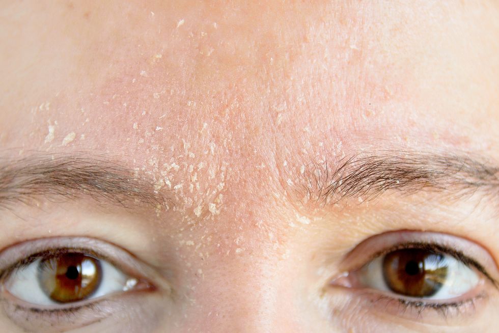 How to remove dry skin flakes in 10 seconds
