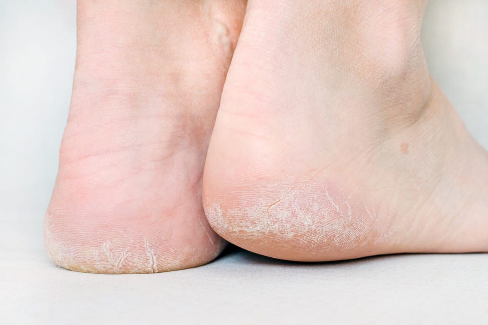 womans feet with dry heels, cracked skin
