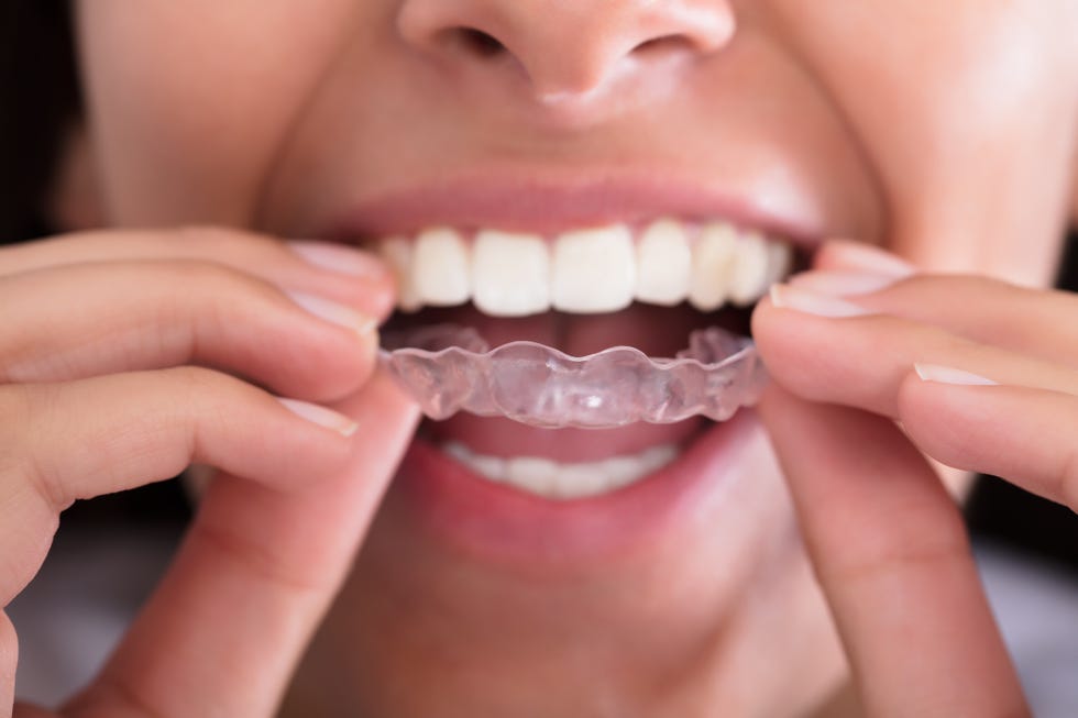 Do Direct-to-Consumer Aligners Like SmileDirectClub Work?