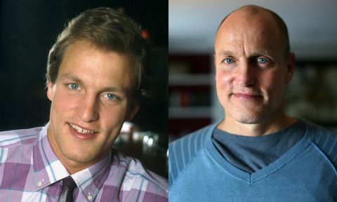 Woody Harrelson bald before and after