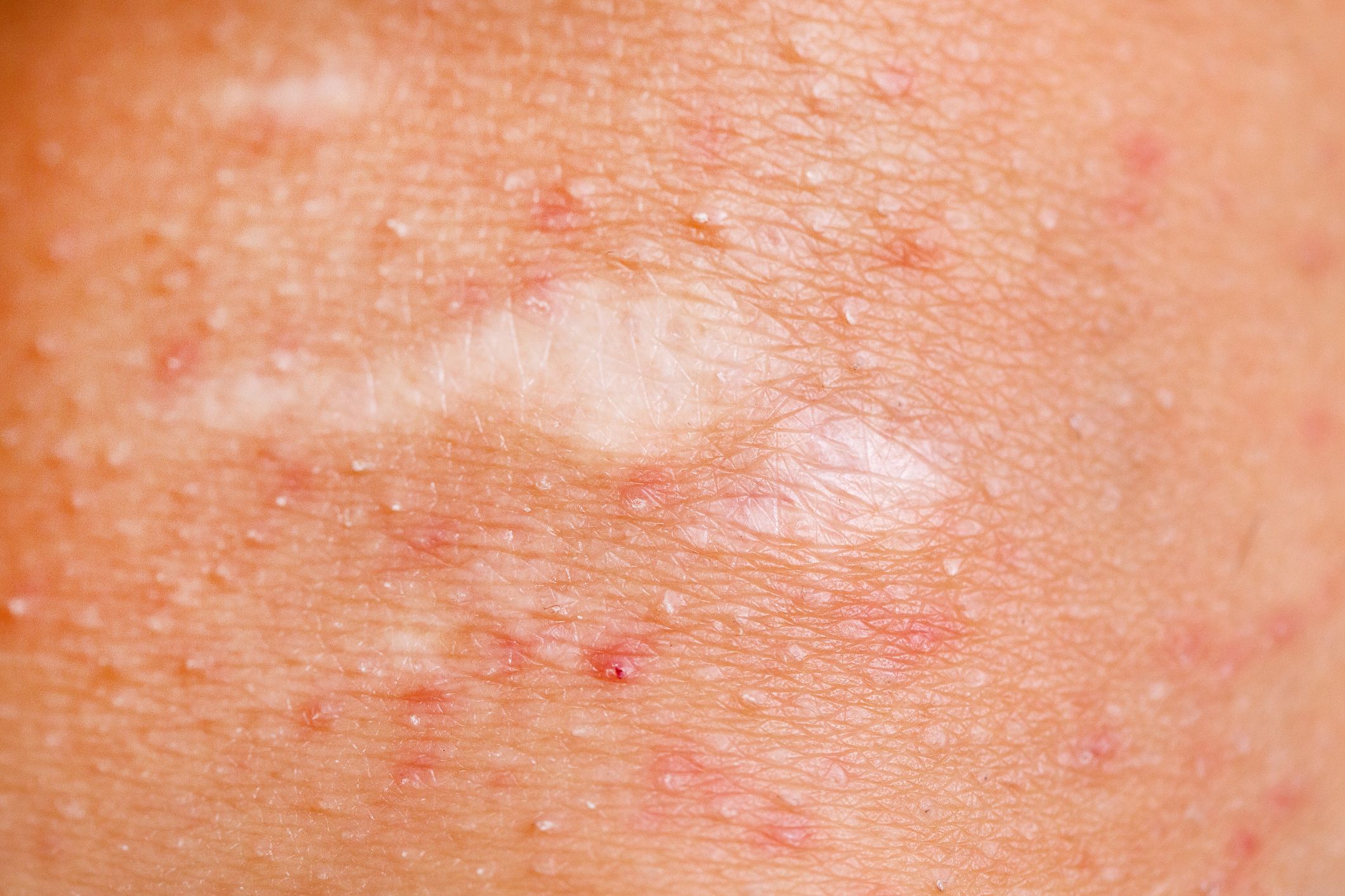 Wound on female knee, irritated skin
