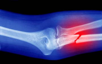 xray of broken arm
