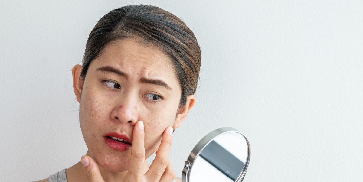 Blind Pimple: What It Is and How to Get Rid of the Type of Acne