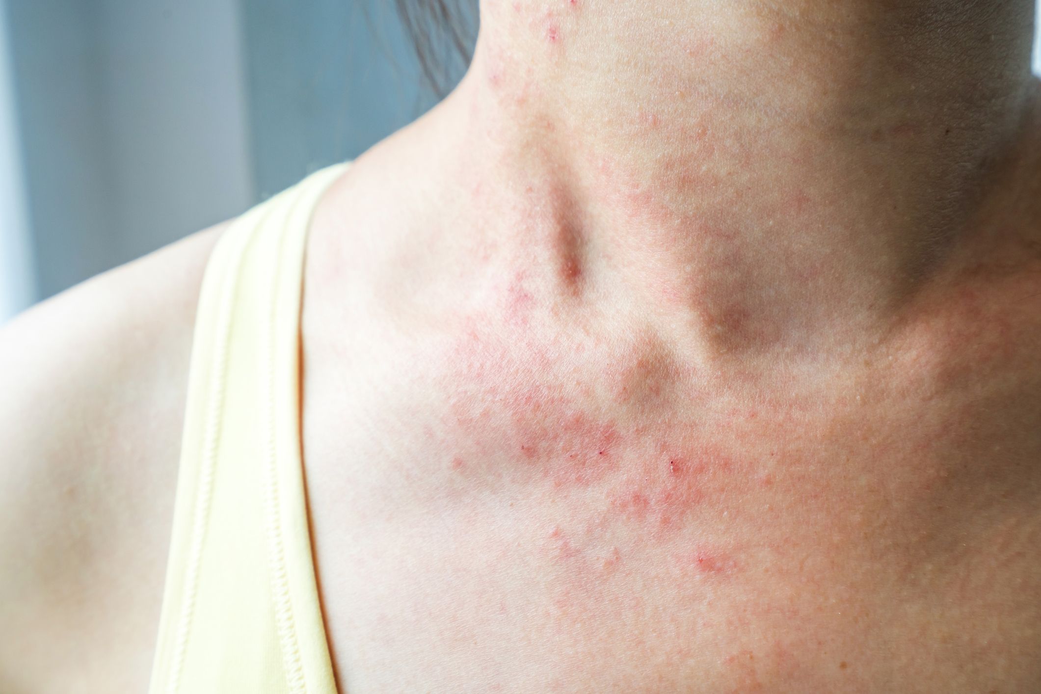 a Skin Rash May Be a Symptom, According to Doctors