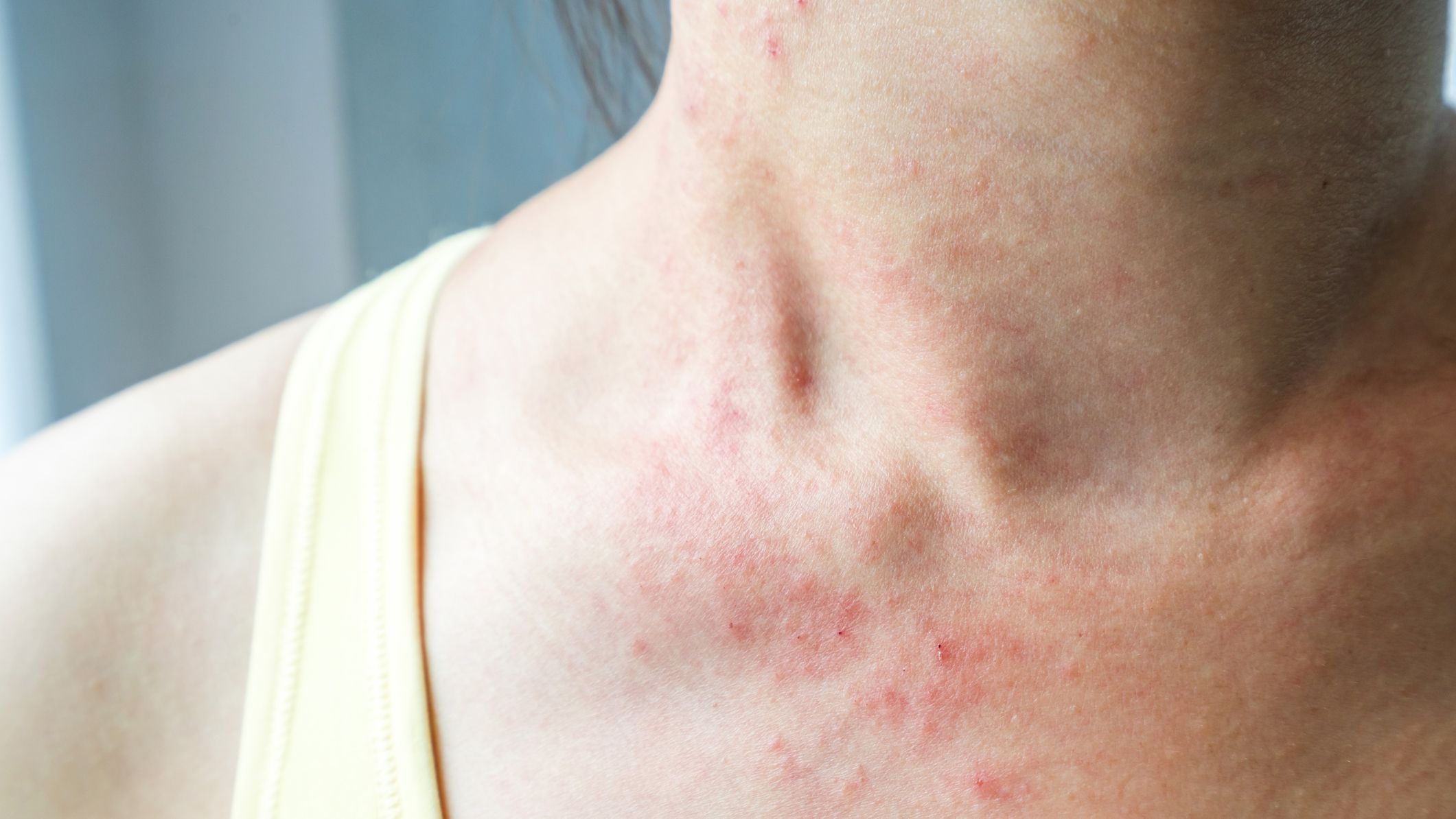Why a Skin Rash May Be a Coronavirus Symptom, According to Doctors
